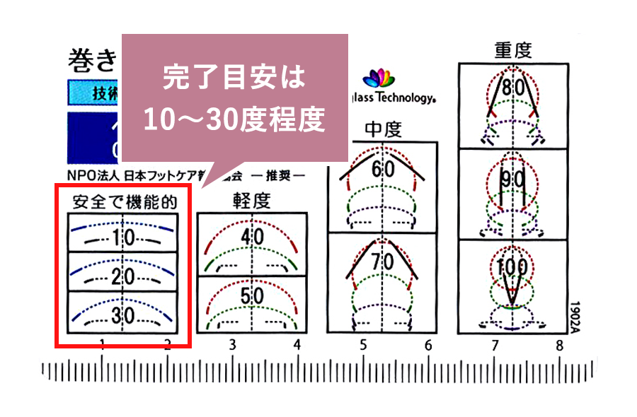 巻き爪治療の完了目安