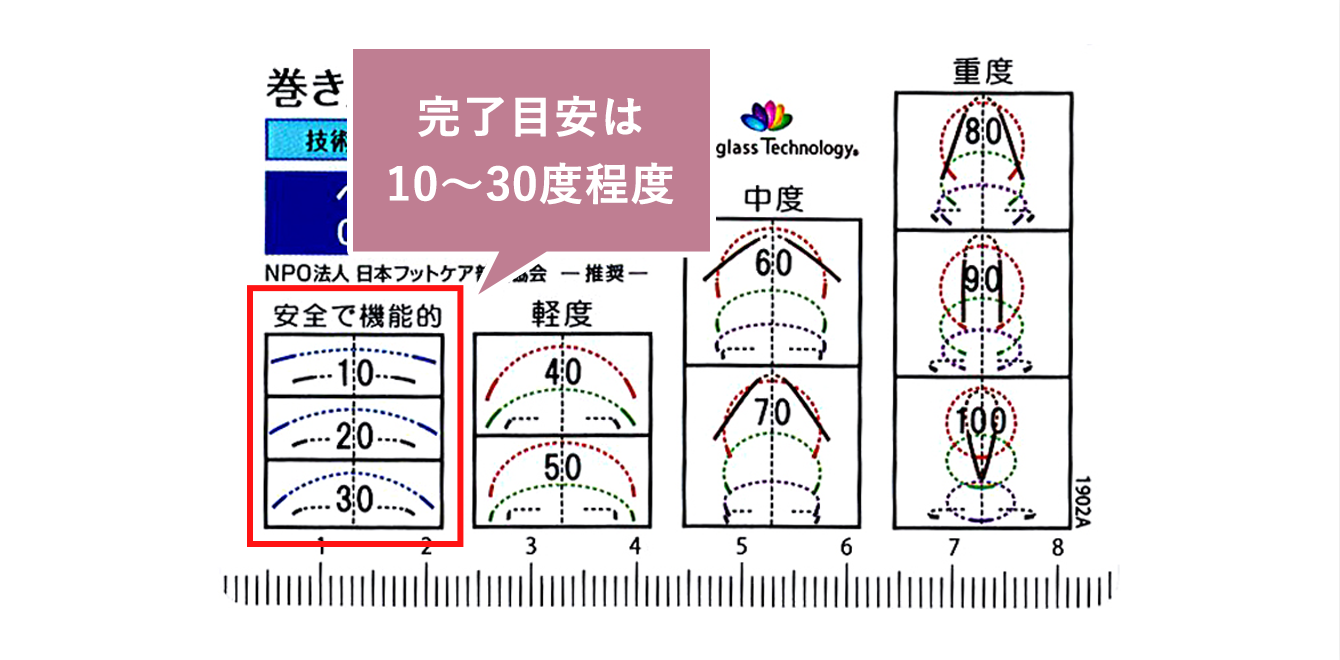 巻き爪治療の完了目安
