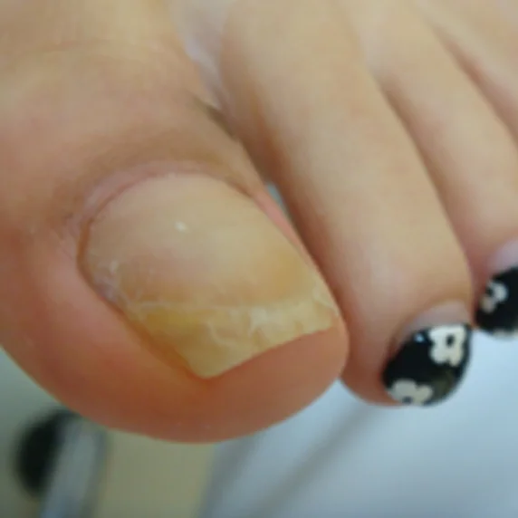 変形爪 After
