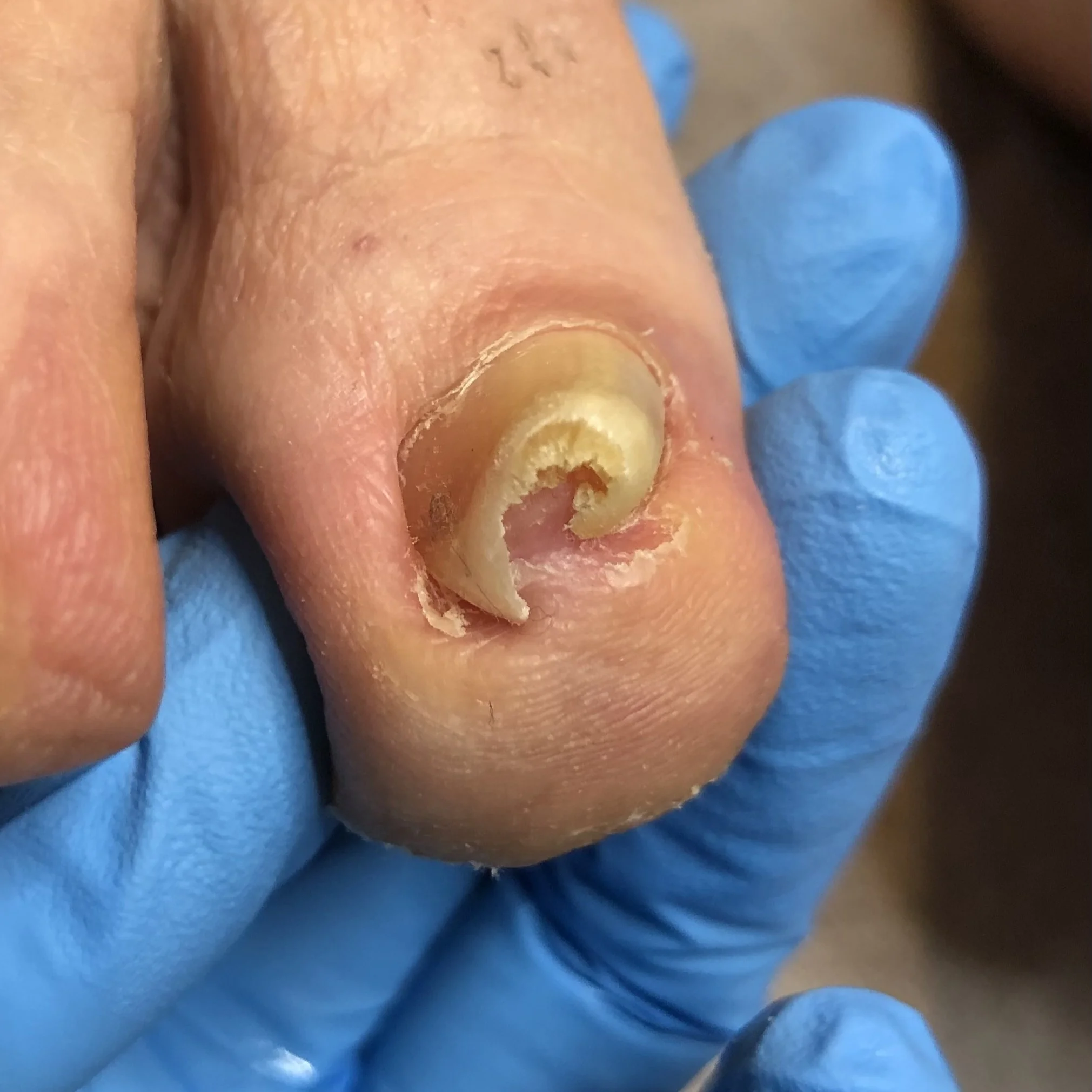 重度の巻き爪 Before