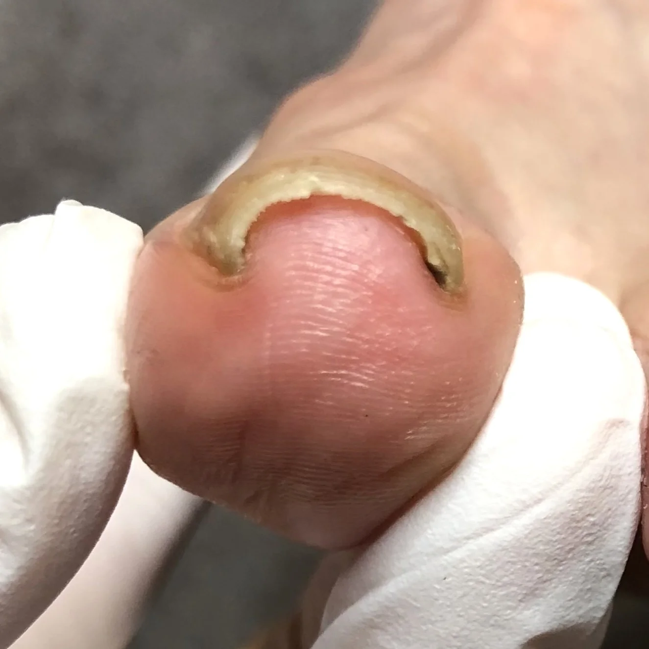 軽度の巻き爪 before
