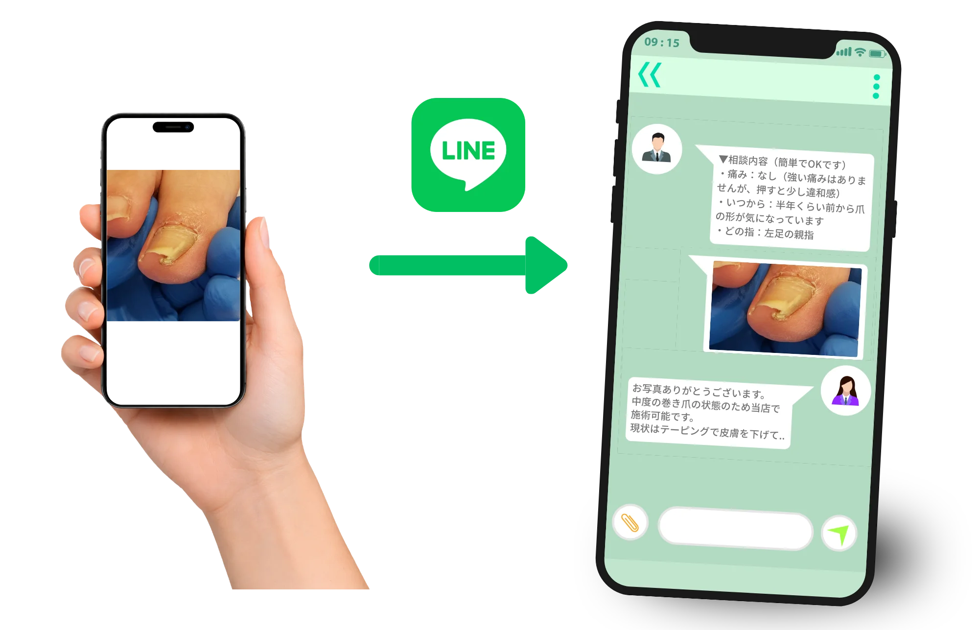 LINEで巻き爪の写真を送って相談する流れ