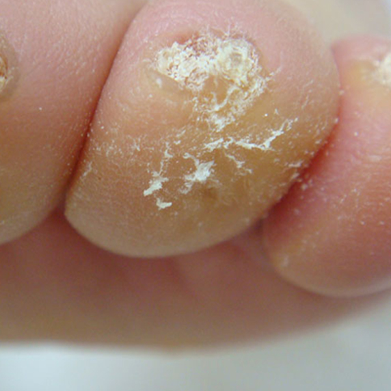 角質ケア